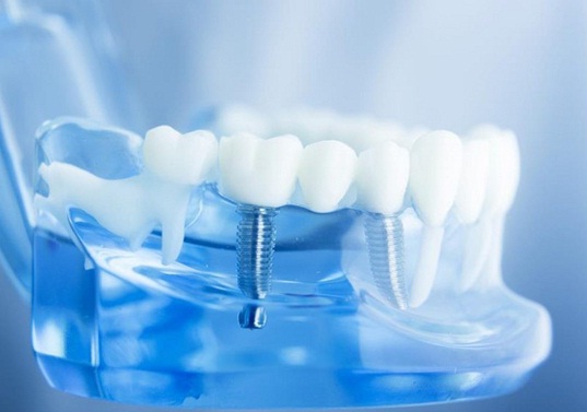 CÁY GHÉP IMPLANT