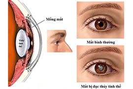 Phục hồi hoàn toàn mắt bị đục thủy tinh thể không cần phẫu thuật