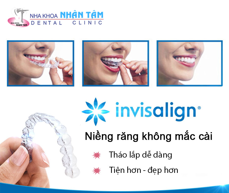 Niềng răng không mắc cài