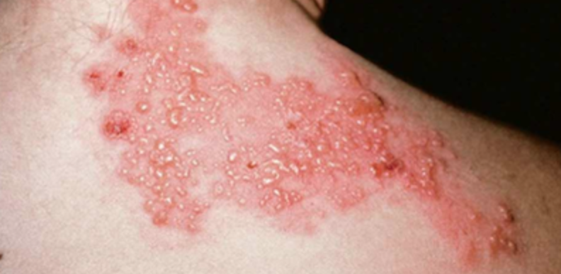 Bệnh zona (herpes zoster)