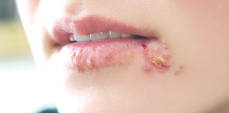 Bệnh mụn rộp (herpes)