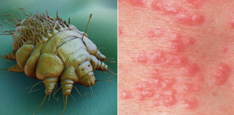 Bệnh ghẻ (scabies, gale)