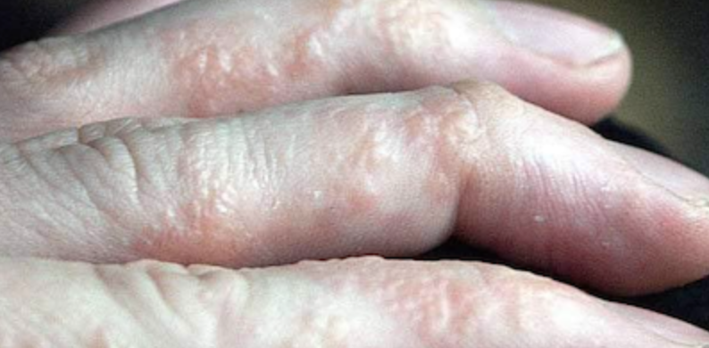 Tổ đỉa (dyshidrotic eczema, dyshidrotic dermatitis, pompholyx)
