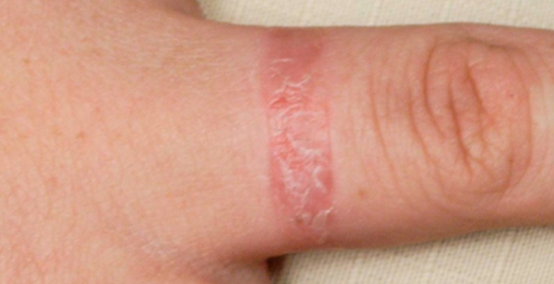 Viêm da tiếp xúc (contact dermatitis)