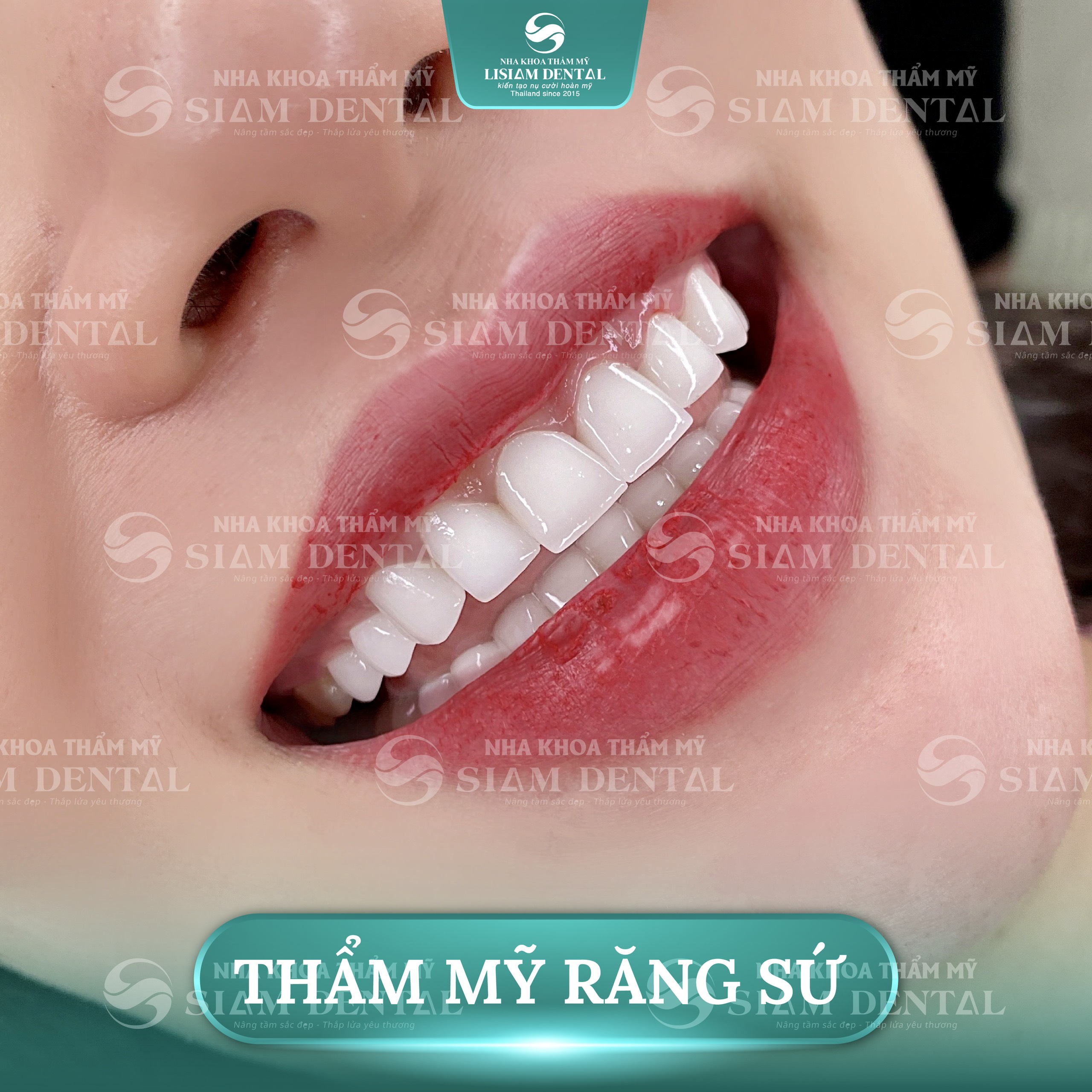 Bọc răng sứ thẩm mỹ