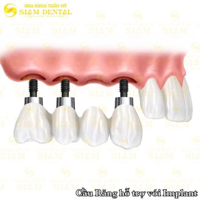 PHỤC HÌNH RĂNG MẤT