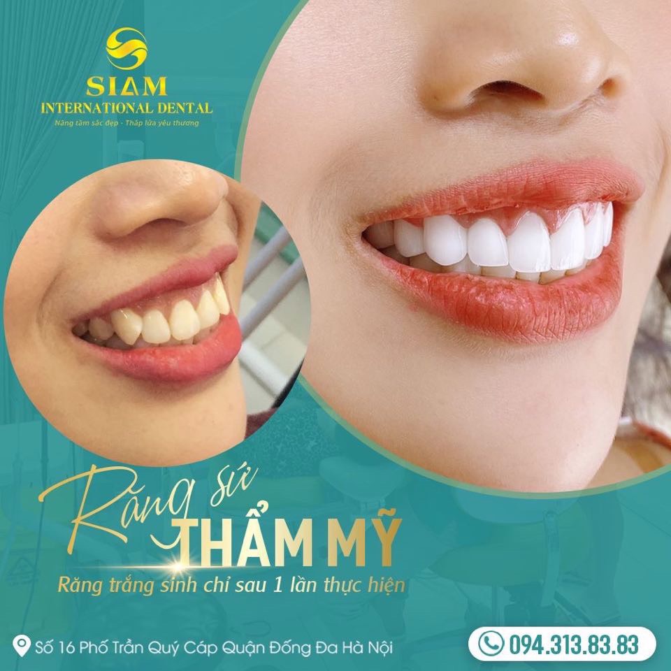 CHỮA CƯỜI HỞ LỢI