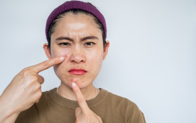 SẢN PHẨM CHO DA DẦU MỤN