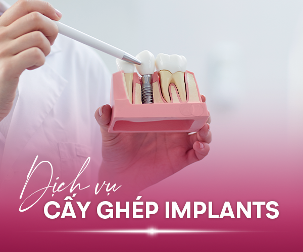 Thay thế răng đã mất hiệu quả và lâu bền