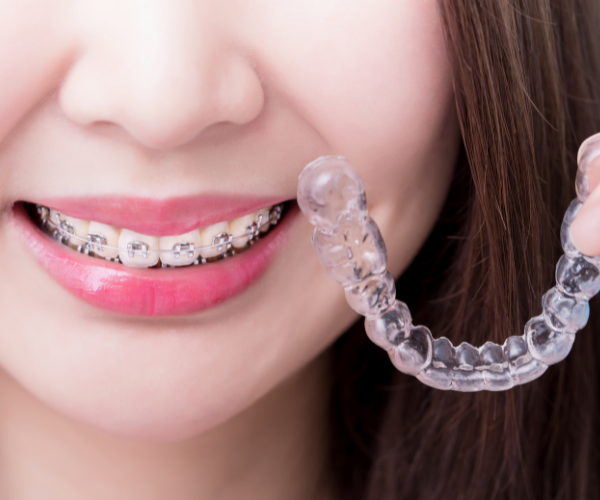 Niềng răng - Chỉnh nha