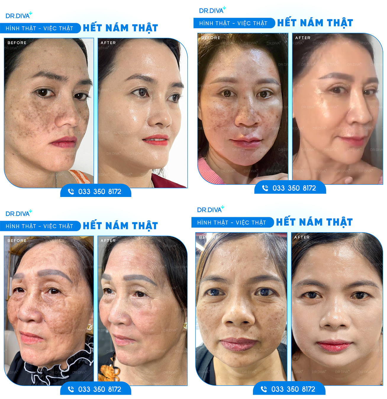 🔹 HÌNH THẬT - VIỆC THẬT - HẾT NÁM THẬT! 🔹 