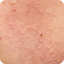 Mụn đầu trắng