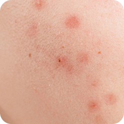 Phục hồi da mụn