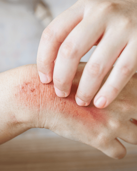 đỏ ngứa da