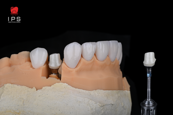 CUSTOMIZED ABUTMENT SỨ TRÊN TIBASE