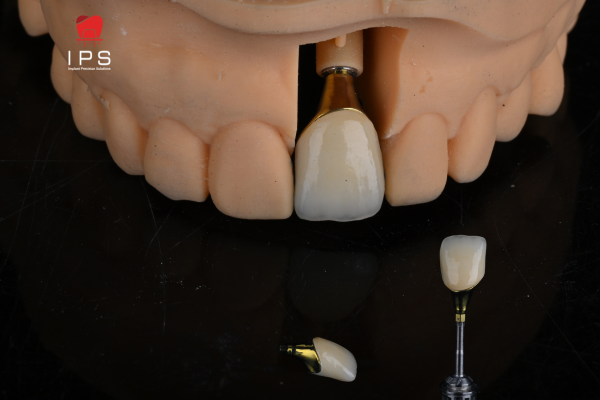 PHỤC HÌNH SỨ TRÊN IMPLANT