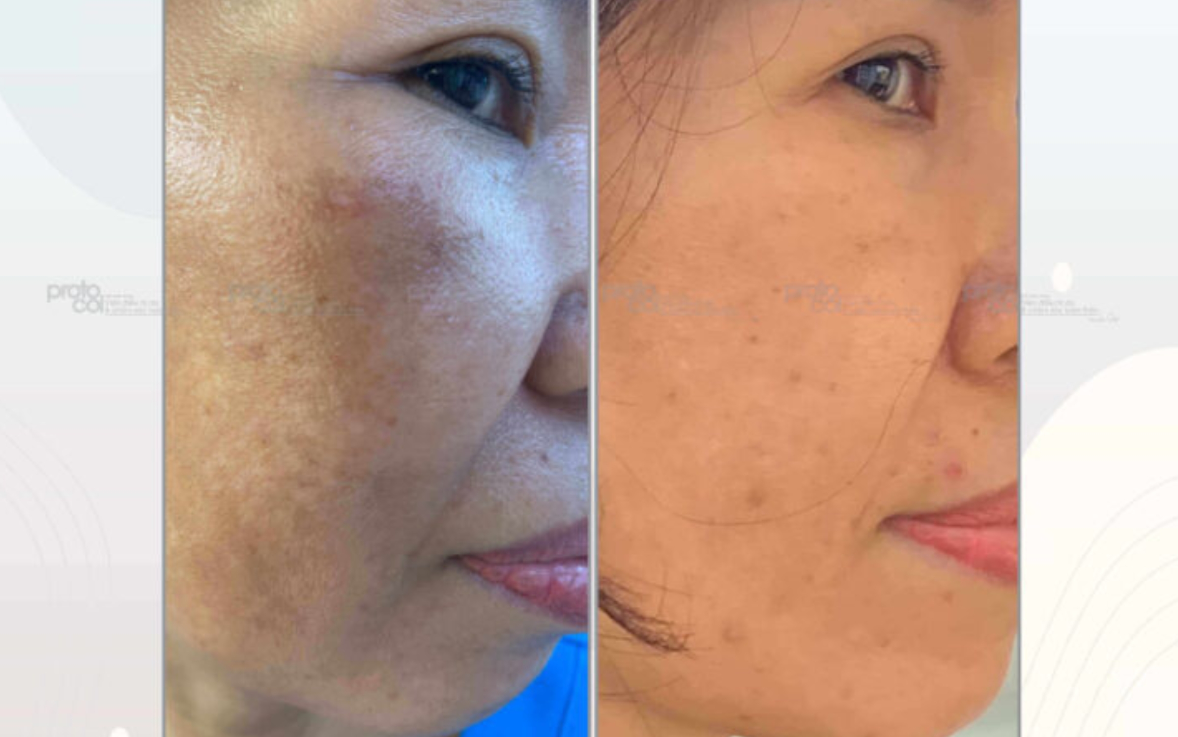 HÌNH ĐIỀU TRỊ TRƯỚC VÀ SAU