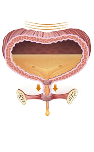 Bí tiểu mạn tính