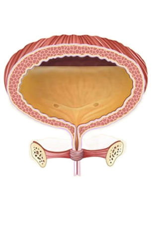 Bí tiểu cấp tính